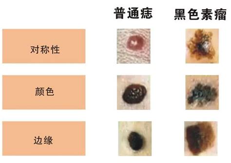 臉上長誌|是痣還是瘤？黑色素瘤的類型、症狀與治療